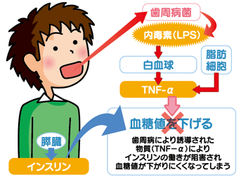 歯周病により誘導された物質(TNF-α)によりインスリンの働きが阻害され血糖値が下がりにくくなってしまう